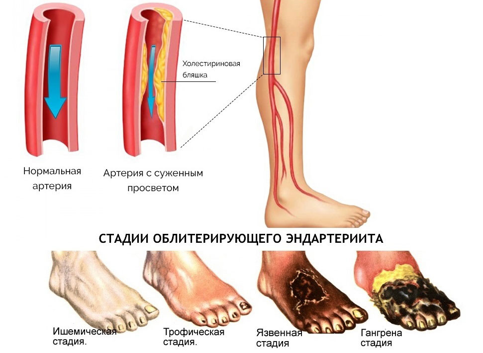 Ревматоидный артрит ног: лечение и симптомы - статьи от компании Еламед