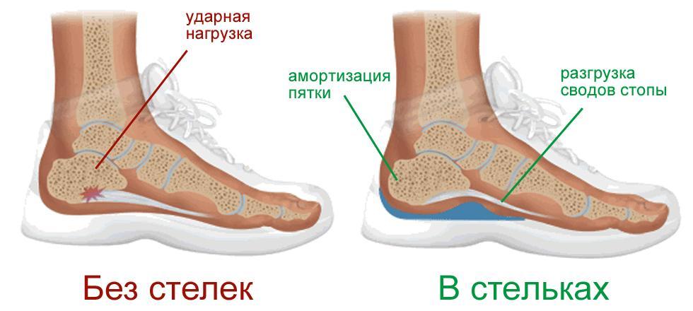 Работа ортопедических стелек