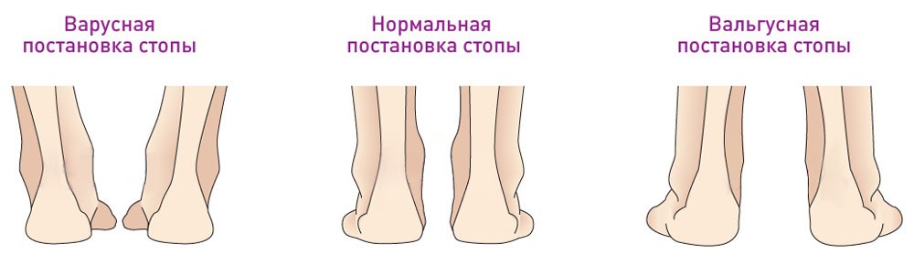 Варусная и вальгусная стопа