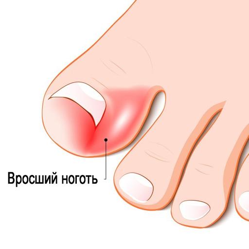 вросшие ногти